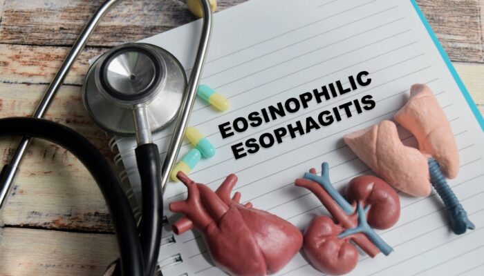 Key factors to know about eosinophilic esophagitis