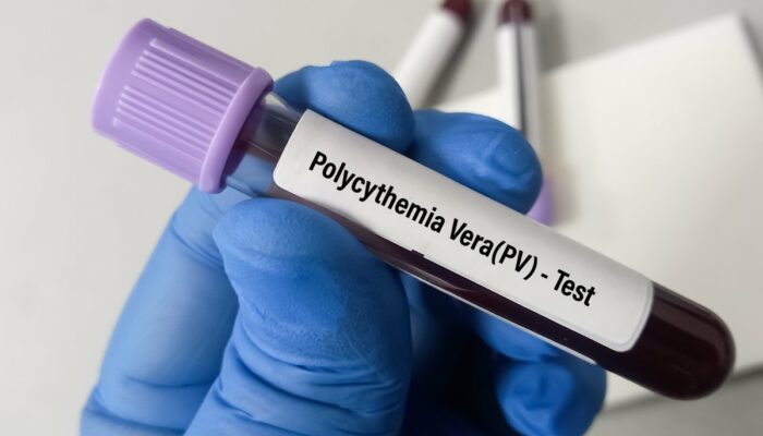 Polycythemia vera – Symptoms and risk factors