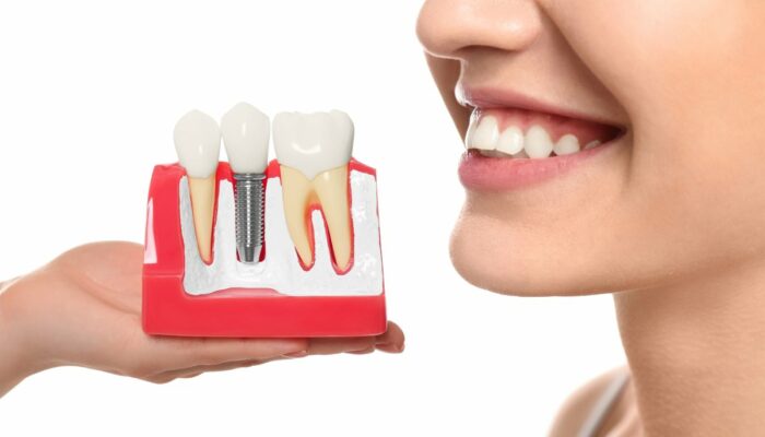 Ways to find affordable dental implants